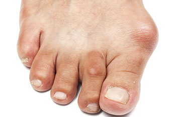 Bunions Treatment Bunions treatment in the San Juan, 00924, Puerto Rico area