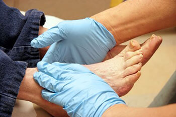 Diabetic foot care Diabetic foot treatment and care, Diabetic Ulcers Treatment & Management in the San Juan, 00924, Puerto Rico area