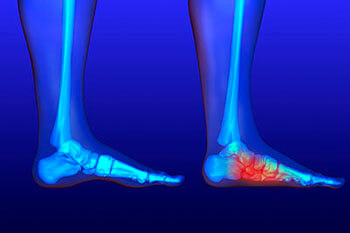 Flat Feet Treatment Flat feet and Fallen Arches treatment, Flatfoot Deformity Treatment in the San Juan, 00924, Puerto Rico area