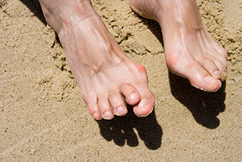 Hammertoes causes, risks, prevention and treatment Hammertoes & Mallet Toes treatment in the San Juan, 00924, Puerto Rico area