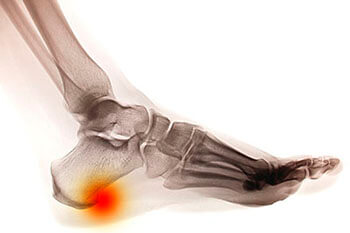 Heel Spurs Treatment Heel spurs treatment in the San Juan, 00924, Puerto Rico area