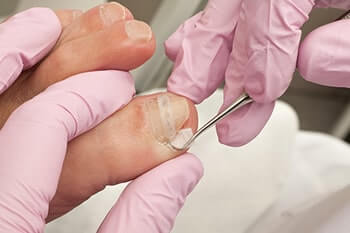 Ingrown Toenails Treatment in San Juan, 00924, Puerto Rico Ingrown toenails treatment in the San Juan, 00924, Puerto Rico area