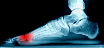 Morton's Neuroma Treatment Mortons neuroma treatment in the San Juan, 00924, Puerto Rico area