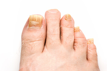 Toenail fungus treatment in San Juan, 00924, Puerto Rico Fungal toenails, toenail fungus diagnosis and treatment in the San Juan, 00924, Puerto Rico area