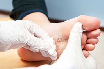 Plantar Warts Treatment Plantar warts treatment in the San Juan, 00924, Puerto Rico area
