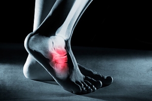 A Rare Genetic Disease and Its Link to Foot Stress Fractures